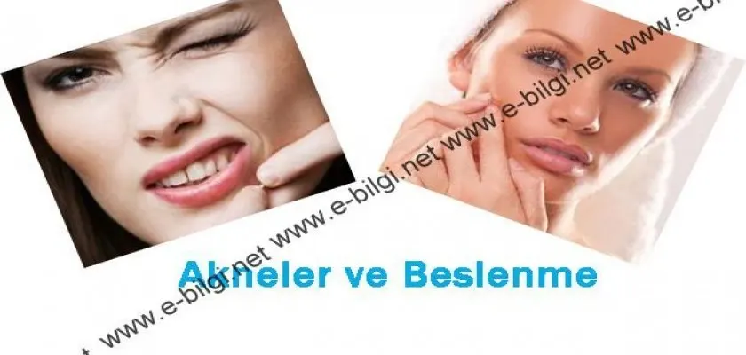 Akneler ve Beslenme 