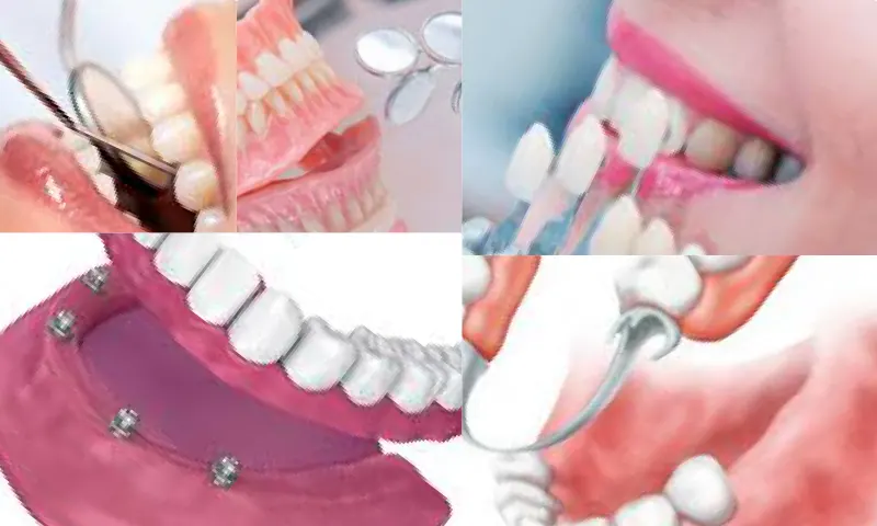 Protez Diş Nedir, Protetik Diş Tedavisinde Kullanılan Protez Türleri Nelerdir