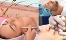 İğne Lazer Nedir?