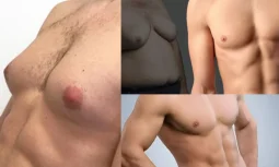 Jinekomasti Ameliyatı Kalıcı Bir Çözüm Müdür?
