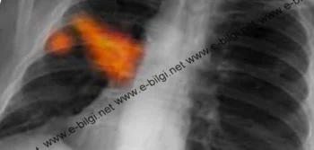 Akciğer Kanseri Belirtileri Neledir, Nasıl Anlaşılır?