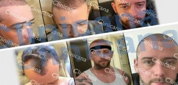 Saç Ekimi Ne Kadar Güvenli