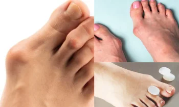 Halluks Valgus Tanı Ve Değerlendirme Süreci