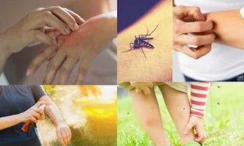 Sivrisineklerden Korunma Yöntemleri